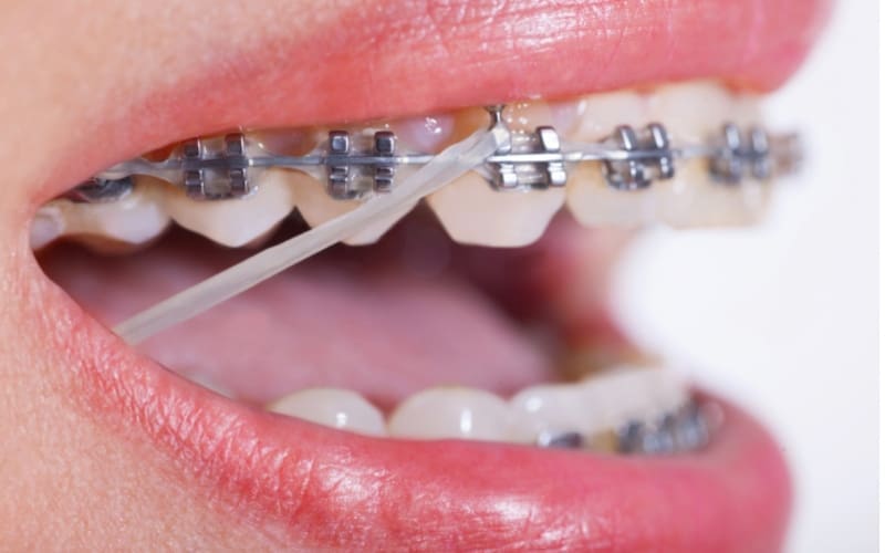 Close-up of a persons mouth with braces and a rubber band connecting the upper and lower braces. The persons lips are partially open, revealing teeth and the metal brackets of the braces.