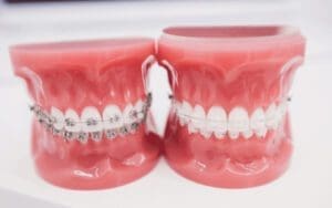 Two dental models showing sets of teeth with different types of braces. The left model has metal braces, while the right model shows clear braces. Both models are placed on a white surface.