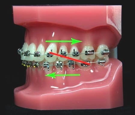 A dental model with braces on teeth, featuring green arrows indicating horizontal force directions and a red arrow showing a diagonal force direction. The model is pink with metallic brackets and wires.