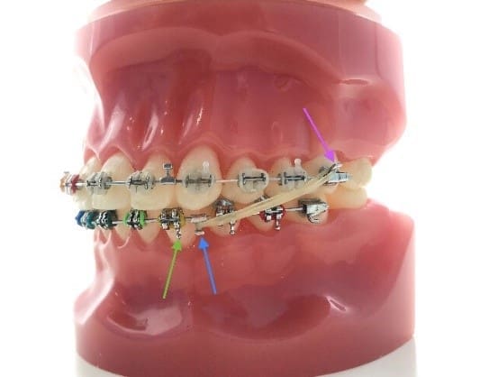 A dental model displaying teeth with metal braces. The braces include colorful ligatures and wires. Arrows point to specific parts of the braces setup, highlighting details of the orthodontic arrangement.