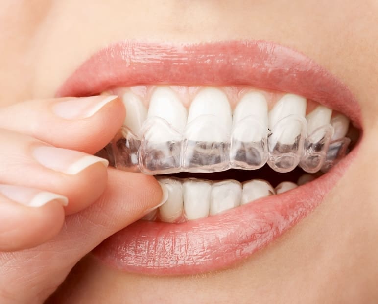 Close-up of a person placing a clear dental aligner over their upper teeth. The image focuses on the aligner fitting snugly around the teeth. The lips are slightly parted, and the fingers are gently holding the aligner.