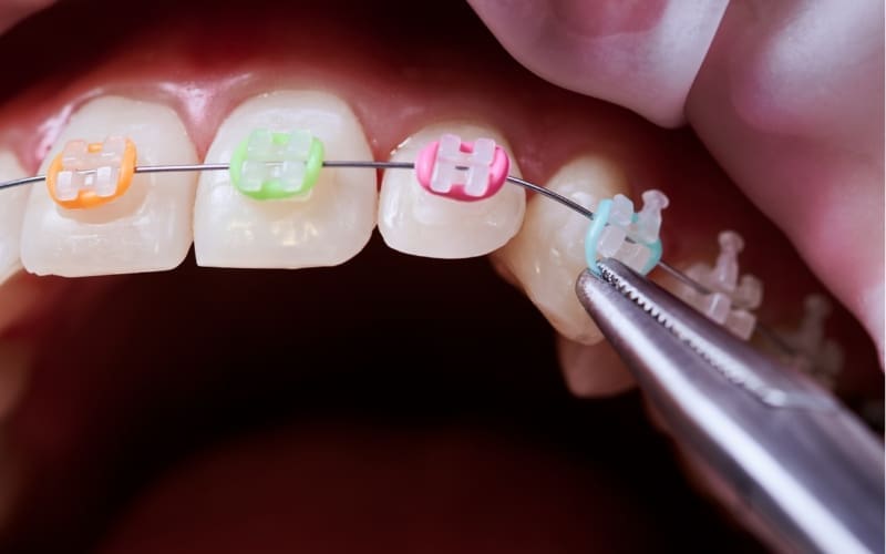 A close-up of teeth with colorful orthodontic brackets and a wire. A dental tool is adjusting a light blue bracket on the rightmost tooth. The brackets are orange, green, and pink from left to right.